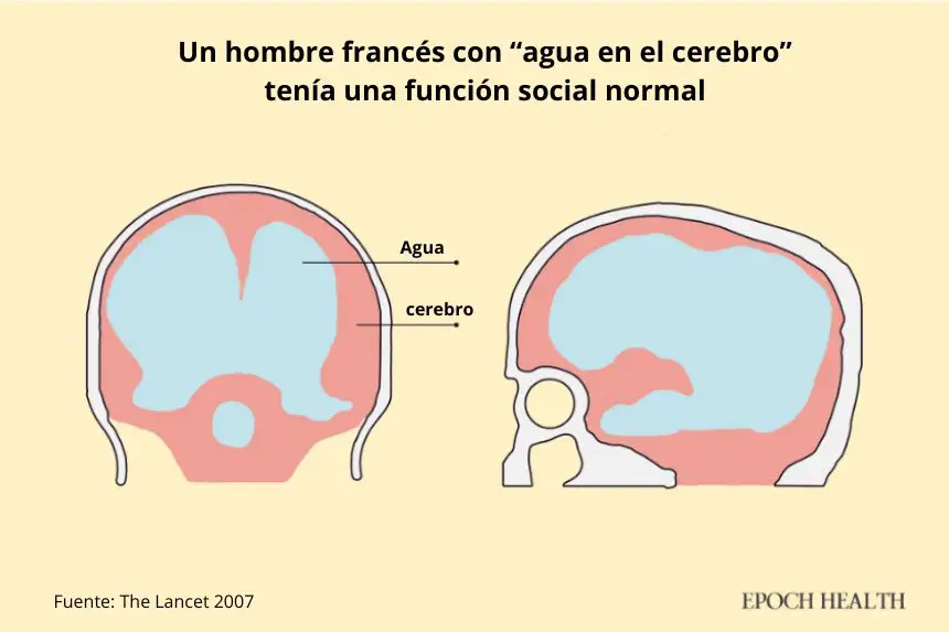 La revista The Lancet registró el caso de un funcionario francés diagnosticado de hidrocefalia postnatal a la edad de 6 meses. Más tarde, una resonancia magnética reveló un agrandamiento masivo de los ventrículos lateral, tercero y cuarto, un manto cortical muy delgado y un quiste de la fosa posterior. (Ilustración por The Epoch Times)