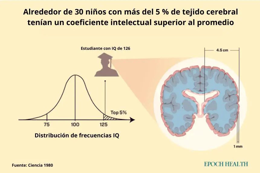 Un análisis de más de 600 casos de niños con hidrocefalia encontró que de los 60 casos en los que el líquido ocupaba el 95 por ciento del cráneo, alrededor de 30 tenían un coeficiente intelectual superior al promedio. El lado derecho de la figura ilustra la imagen cerebral de un estudiante universitario con un cerebro de 1 mm de grosor que tenía un coeficiente intelectual de 126, lo que lo colocaba en el 5 por ciento superior del extremo superior de la población. (The Epoch Times)