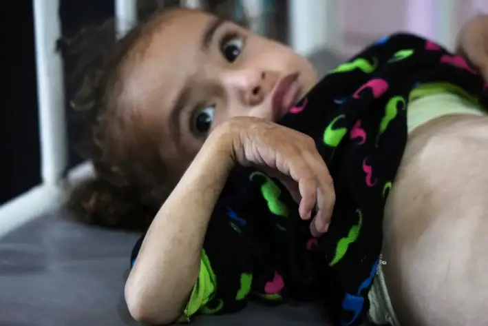 Mayar Al-Arja, de 2 años, que sufre malnutrición, yace en una cama en una clínica del Hospital Nasser, en Jan Yunis, Gaza, el 21 de mayo de 2025. (Abdel Kareem Hana/AP)
