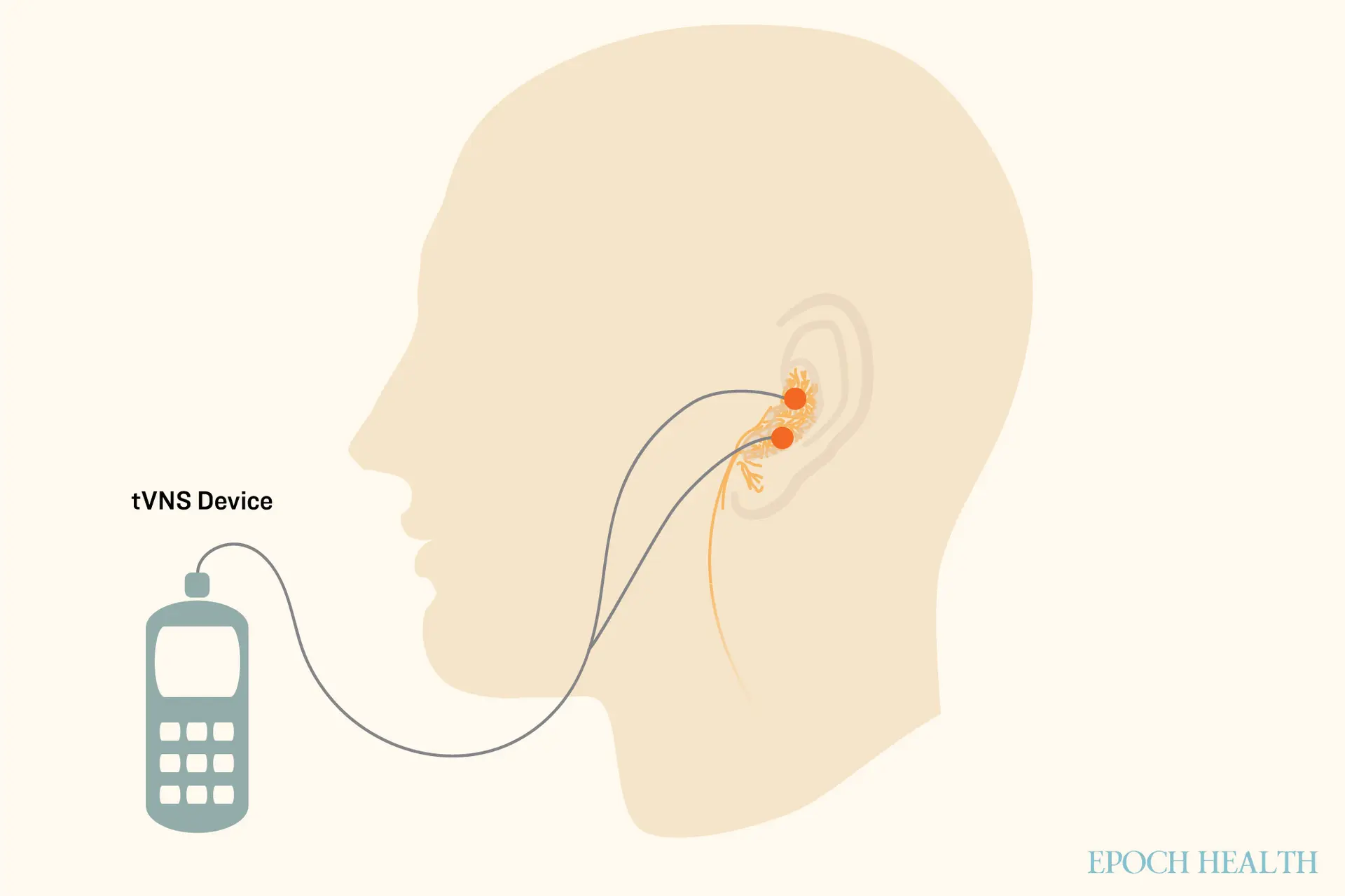 La estimulación transcutánea del nervio vago auricular (taVNS) es un tipo de tVNS que estimula el nervio vago a través del oído. (Ilustración de The Epoch Times / Shutterstock)