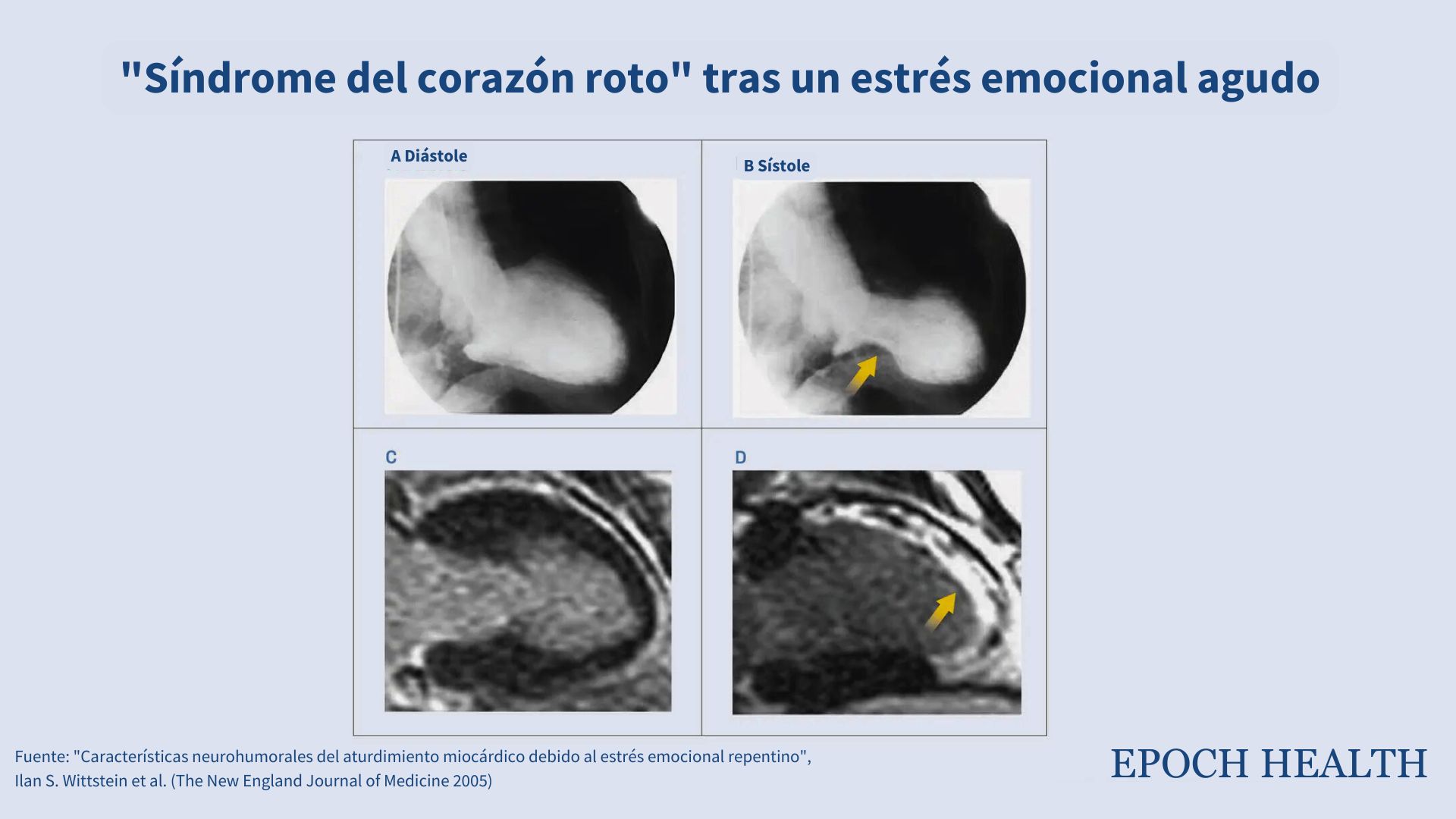 Los paneles A y B muestran que durante el síndrome del corazón roto, partes del corazón dejan de contraerse, pero siguen siendo viables. El panel C confirma que el músculo cardíaco en estas áreas está sano y puede recuperarse. El panel D, a modo de comparación, muestra el daño permanente en el músculo cardíaco causado por un ataque al corazón. (Cortesía de The New England Journal of Medicine ©2005)