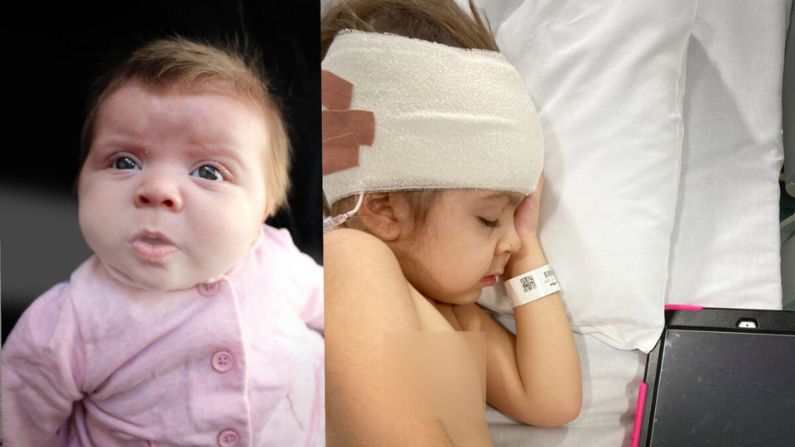 Evie-Mae Geurts, ciega de nacimiento, cuando era un bebé y más tarde en el hospital cuando era niña. (SWNS)
