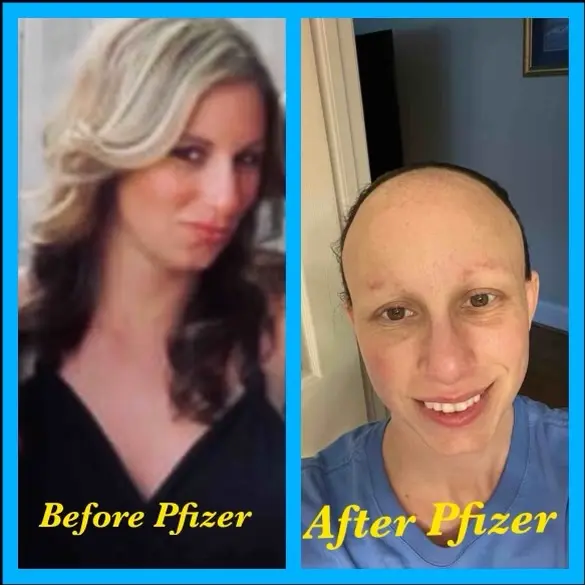 Fotos del antes y el después de Lyndsey House, trabajadora sanitaria que resultó lesionada por la vacuna contra COVID-19 de Pfizer. (Cortesía de Lyndsey House).