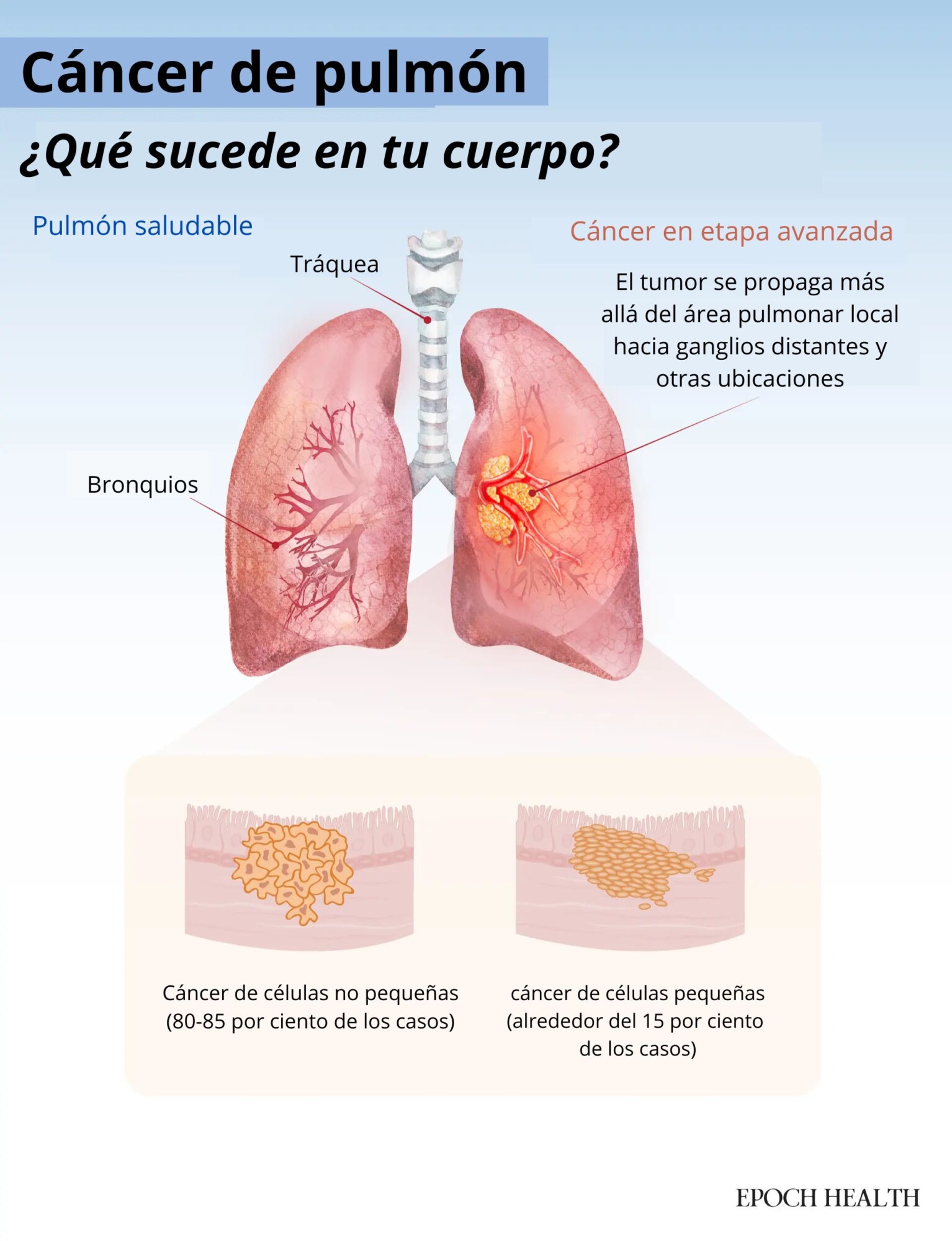 El cáncer de pulmón se produce cuando crecen células anormales en los pulmones. Los dos tipos principales —cáncer de pulmón de células no pequeñas y cáncer de pulmón de células pequeñas— difieren en su crecimiento, propagación y respuesta al tratamiento. (Ilustración de The Epoch Times / Shutterstock).