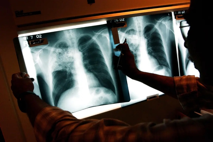 Un médico examina las radiografías de un paciente con tuberculosis en una clínica de Brooklyn, Nueva York, el 27 de noviembre de 2002. Según la OMS, la tuberculosis fue la principal causa de muerte por enfermedad infecciosa en el mundo en 2023, superando a la COVID-19. (Spencer Platt/Getty Images)