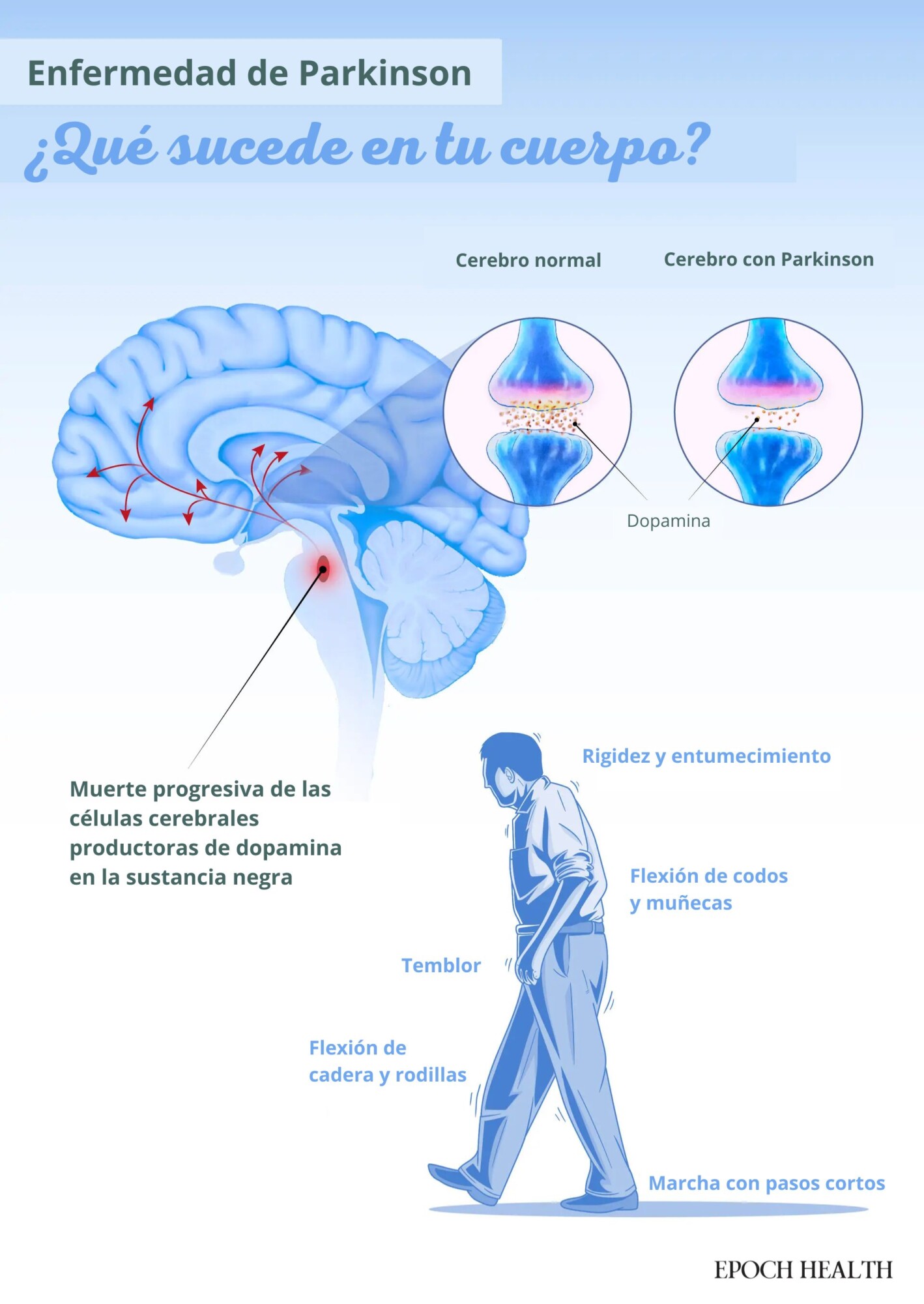 La enfermedad de Parkinson provoca la pérdida de neuronas productoras de dopamina, lo que altera el movimiento y el control emocional. (Ilustración de The Epoch Times/Shutterstock).
