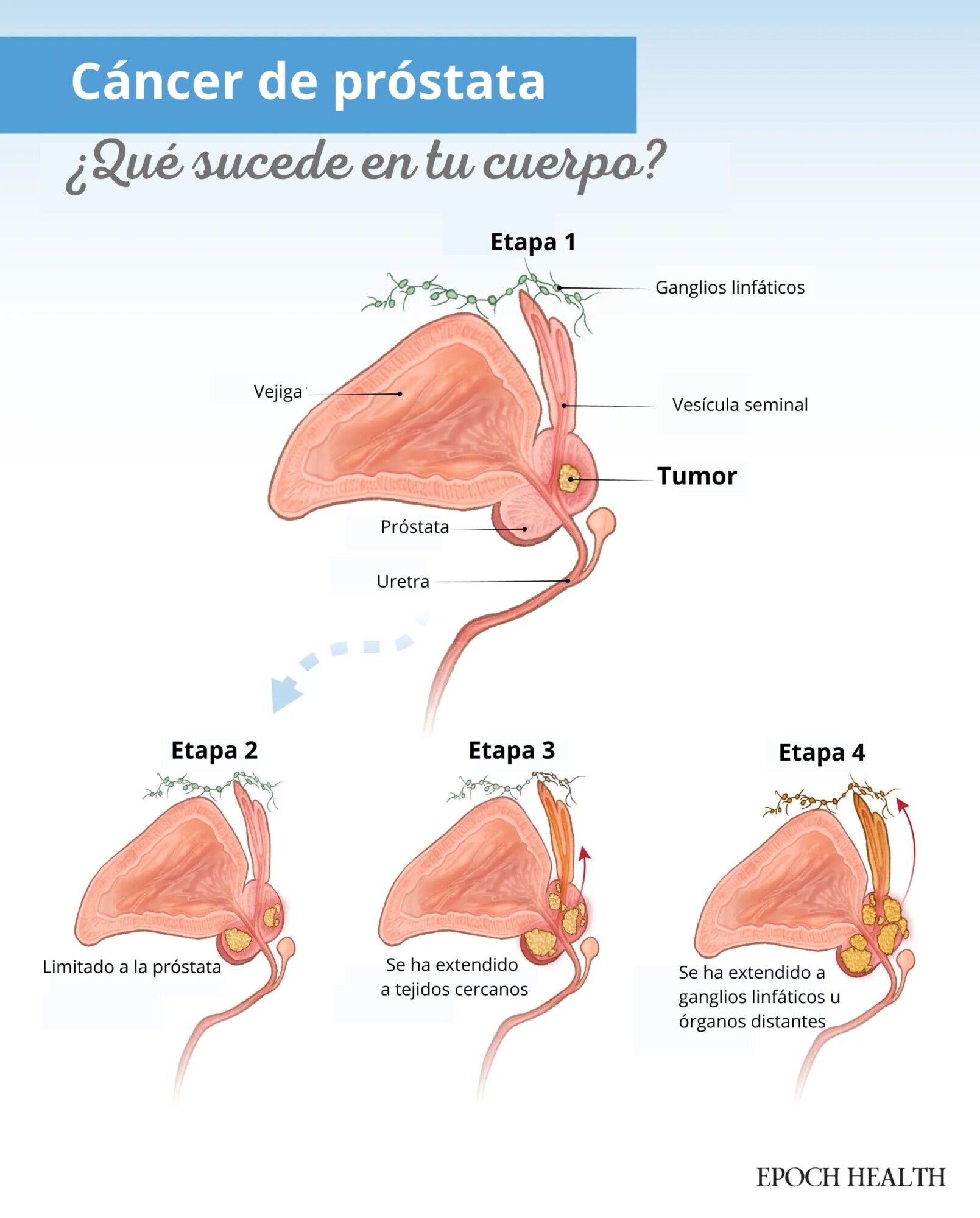 El cáncer de próstata puede progresar desde estar confinado a la próstata hasta propagarse a tejidos cercanos, ganglios linfáticos u órganos distantes. (Ilustración de The Epoch Times, Shutterstock).