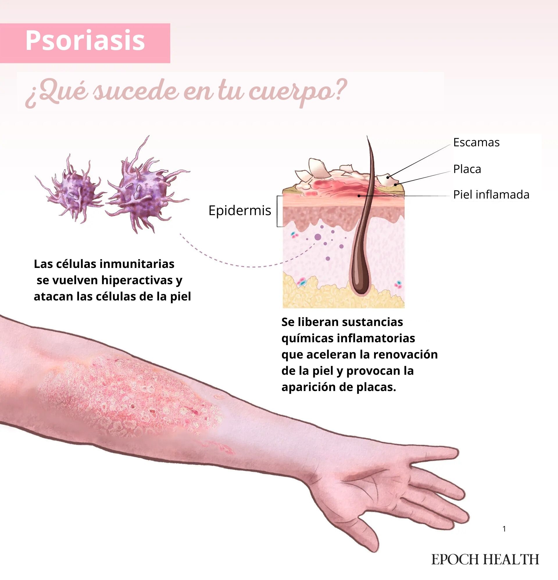 En la psoriasis, la hiperactividad de las células inmunitarias desencadena inflamación y una rápida renovación celular, lo que da lugar a placas gruesas y escamosas en la superficie cutánea. (Ilustración de The Epoch Times, Shutterstock).