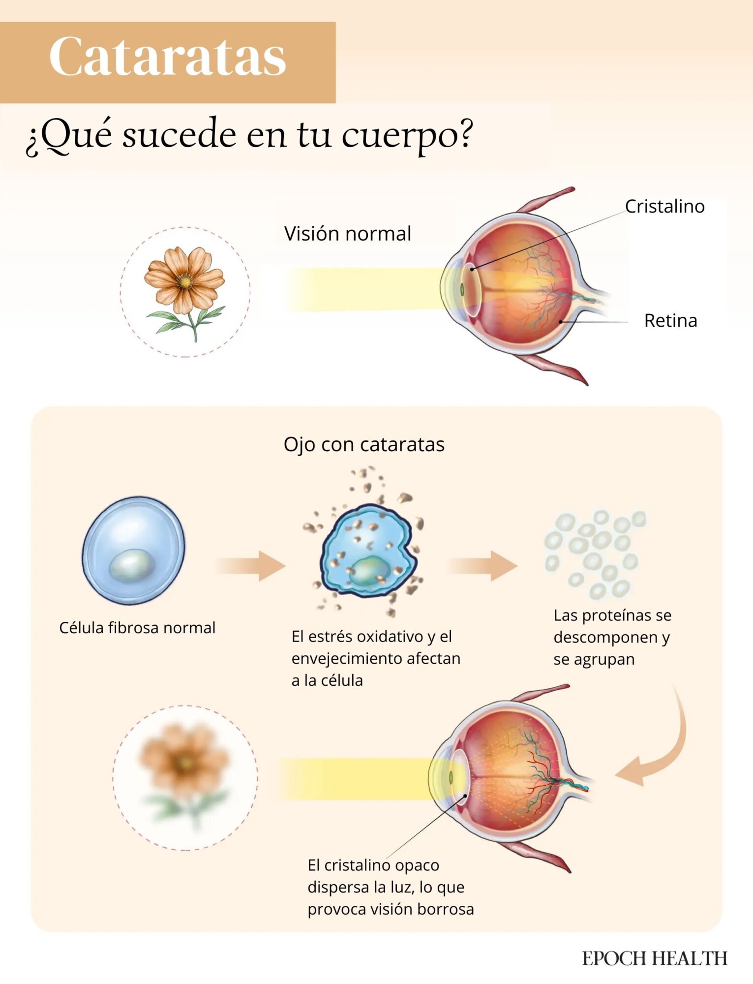 Las cataratas se desarrollan cuando el envejecimiento y el estrés oxidativo dañan el cristalino, lo que provoca la acumulación de proteínas y visión borrosa. (Ilustración de The Epoch Times, Shutterstock).
