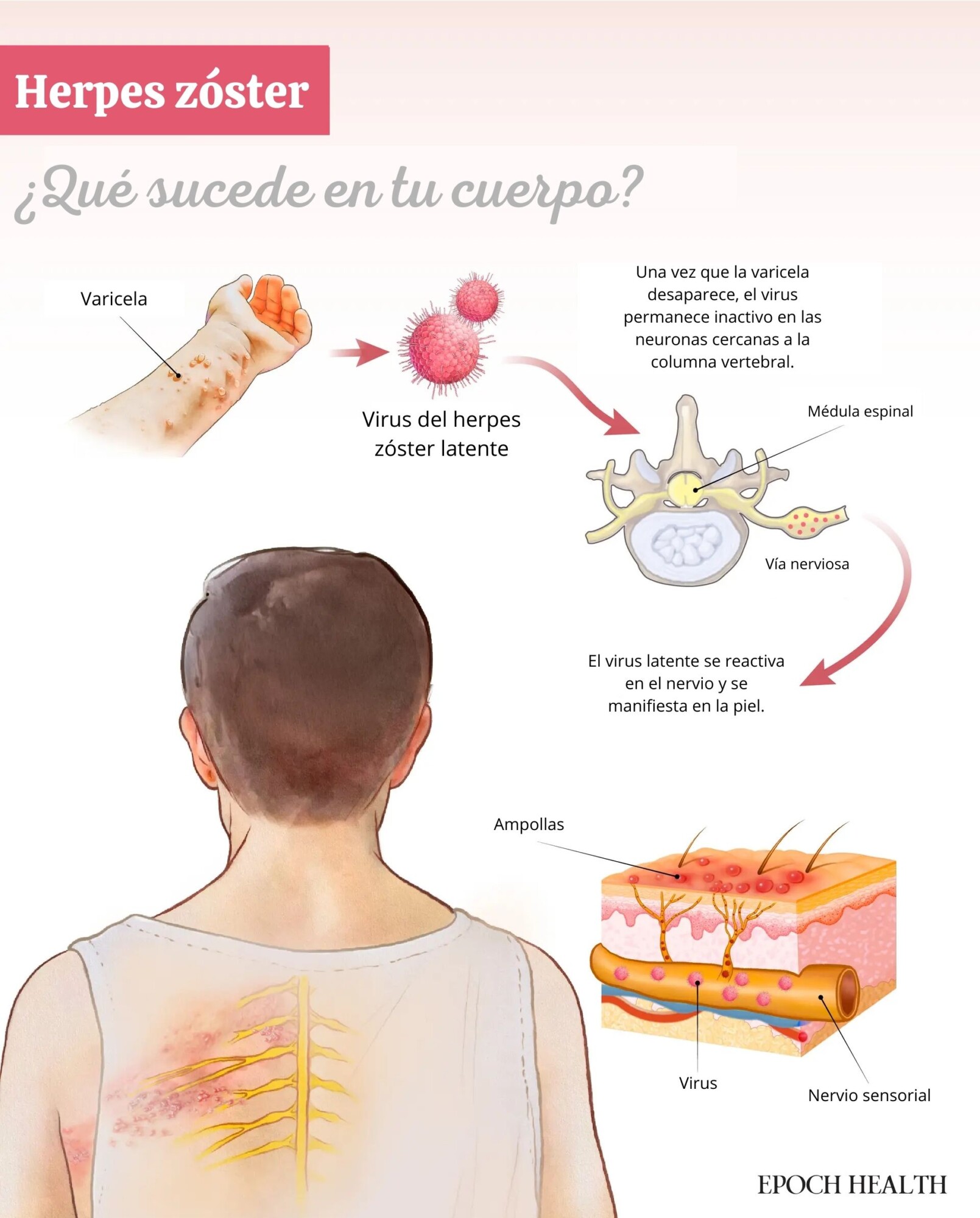 El herpes zóster se desarrolla cuando el virus latente de la varicela se reactiva en los nervios y causa una erupción cutánea dolorosa. (Ilustración de The Epoch Times, Shutterstock).