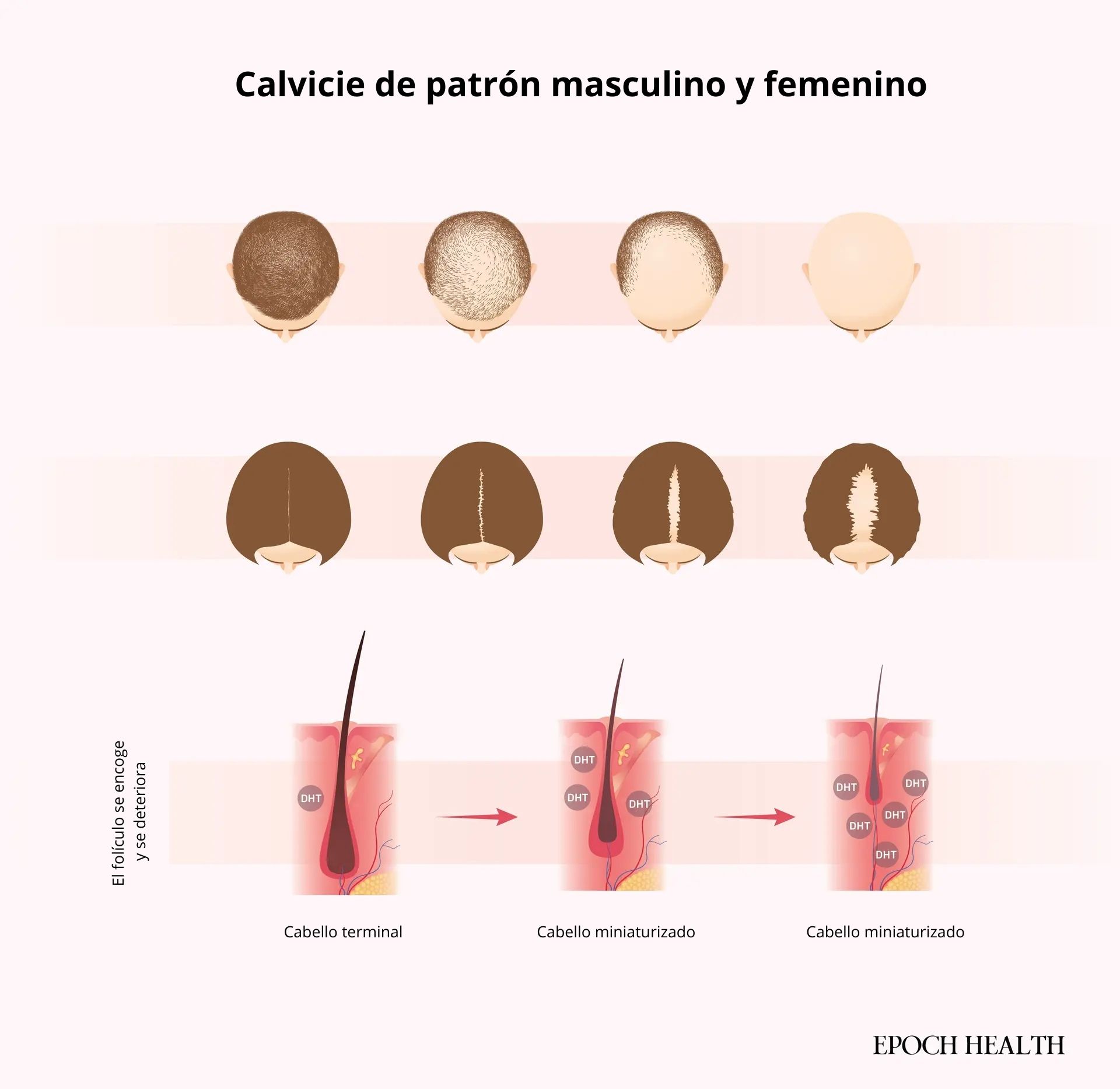 En personas con alopecia androgenética, la dihidrotestosterona (DHT) ataca los folículos pilosos, lo que provoca adelgazamiento del cabello. El patrón de caída del cabello varía entre hombres y mujeres. (Ilustración de The Epoch Times, Shutterstock).