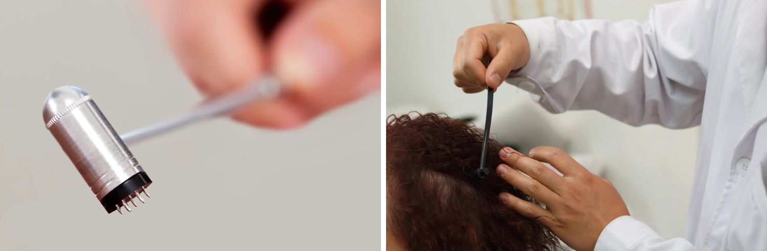 Los practicantes de la medicina tradicional china pueden usar agujas de flor de ciruelo para estimular el crecimiento del cabello. (Tyler Olson, enmyo/Shutterstock)