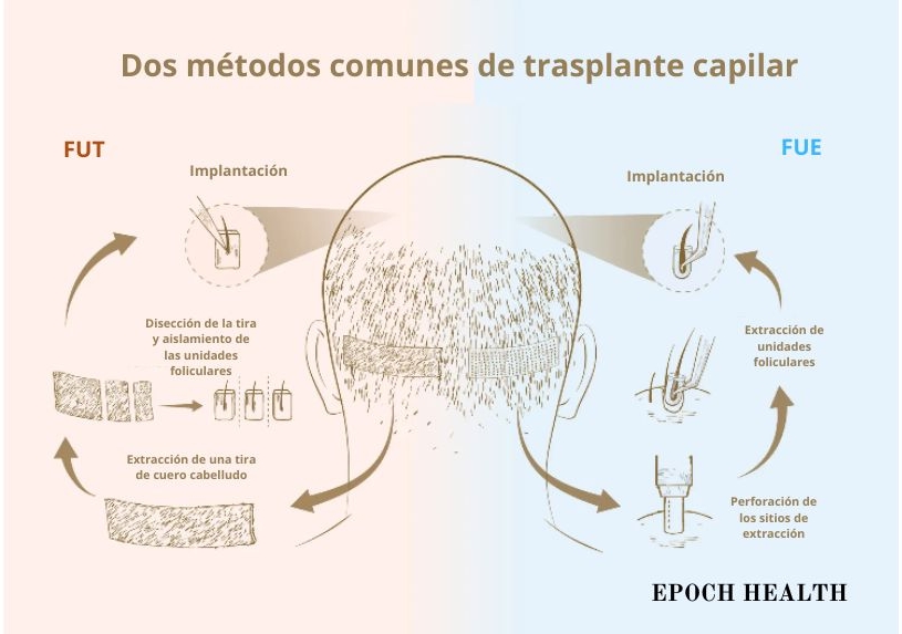 En la cirugía de trasplante capilar se utilizan comúnmente dos métodos: el trasplante de unidades foliculares (FUT), también conocido como técnica de la tira y la extracción de unidades foliculares (FUE). (Ilustración de The Epoch Times, Shutterstock)