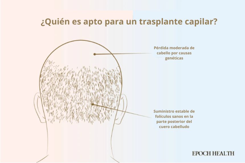 Personas aptas para un trasplante capilar. (Ilustración de The Epoch Times, Shutterstock)