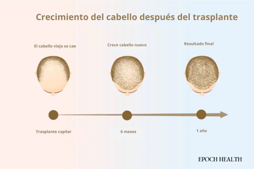 Los resultados del trasplante capilar se aprecian un año después. (Ilustración de The Epoch Times, Shutterstock)