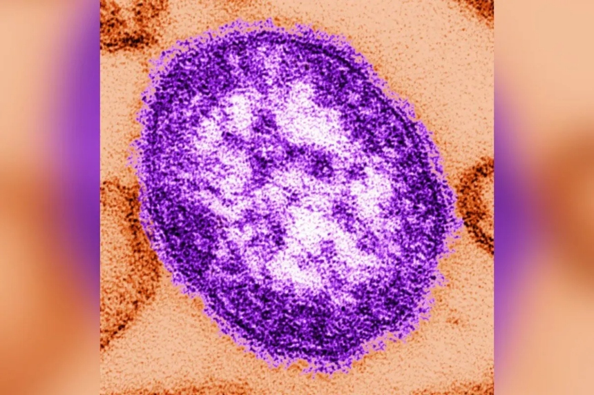 Esta imagen sin fecha, facilitada por los Centros para el Control y la Prevención de Enfermedades, muestra una imagen de microscopio electrónico de una partícula del virus del sarampión, el 4 de febrero de 2015. (The Canadian Press/AP-Cynthia Goldsmith/Centros para el Control y la Prevención de Enfermedades a través de AP)